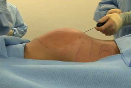 Buttock Surgery